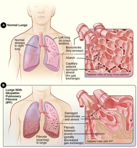 arriba sno, abajo con fibrosis pulmonar